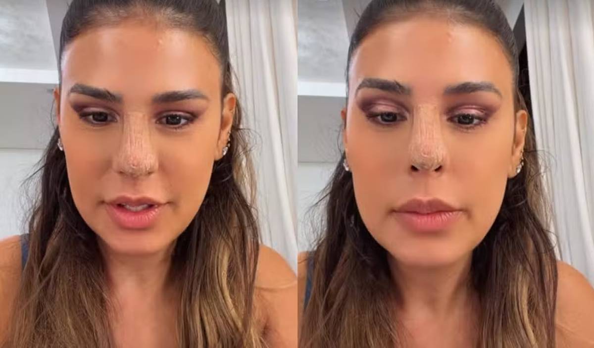 Simone Mendes revela susto após procedimento estético no nariz